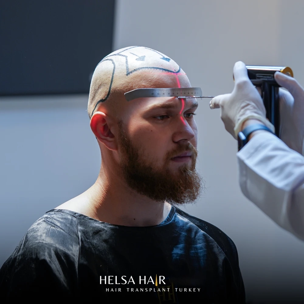 Hair Transplant Results