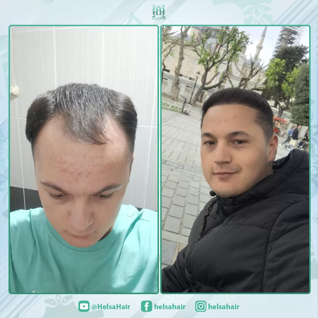 Saç Ekim Sonucu 2