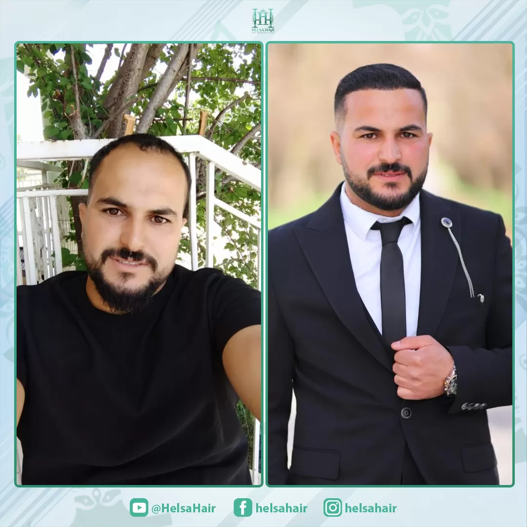 Saç Ekim Sonucu 3
