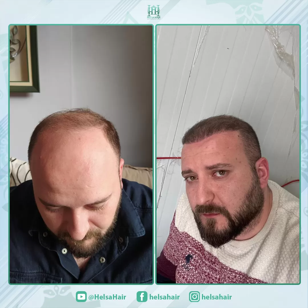 Saç Ekim Sonucu 1