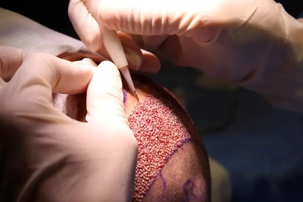 Was ist eine Haartransplantation?