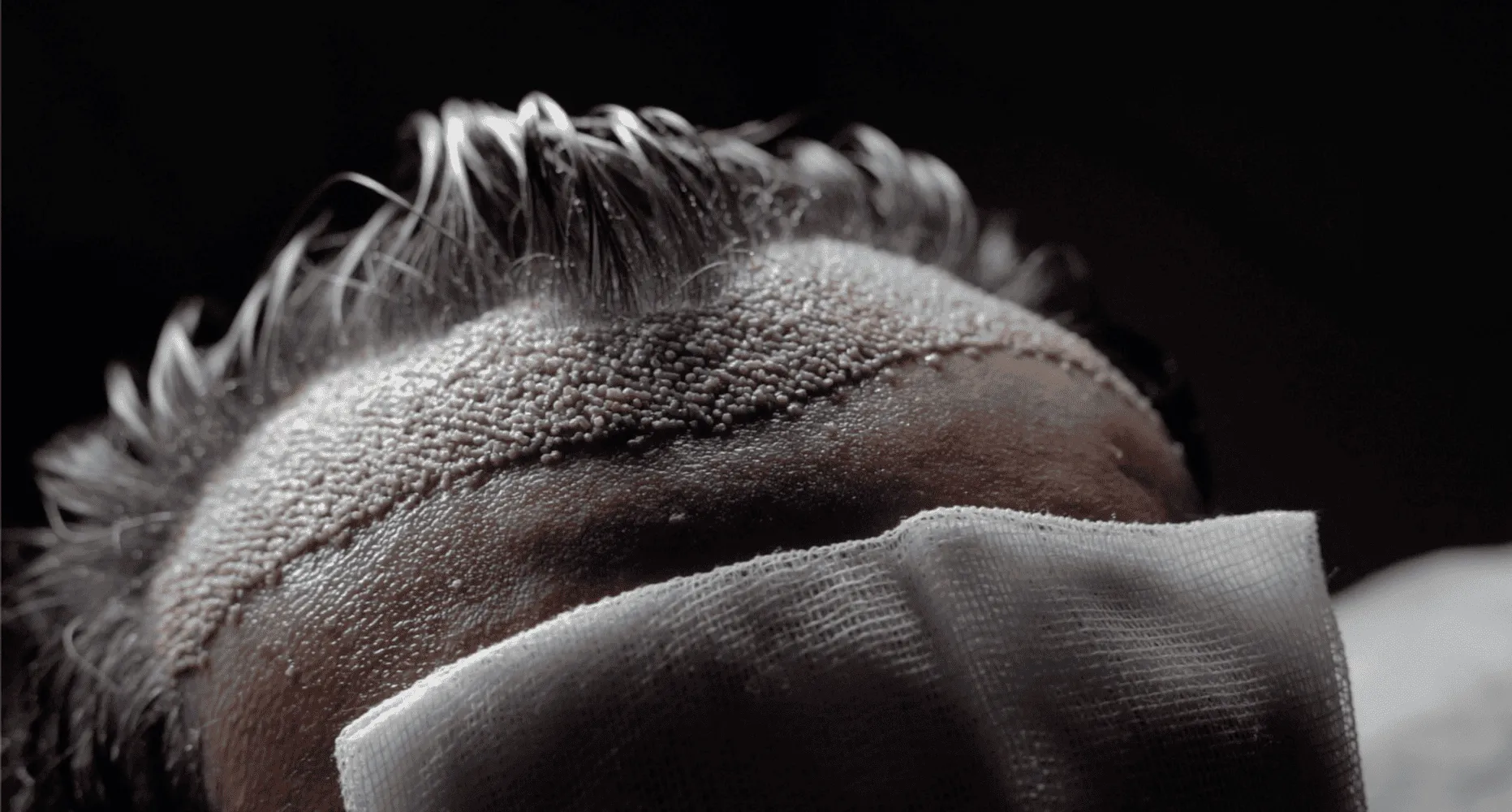 10 Dinge, die Sie vor einer Haartransplantation wissen müssen