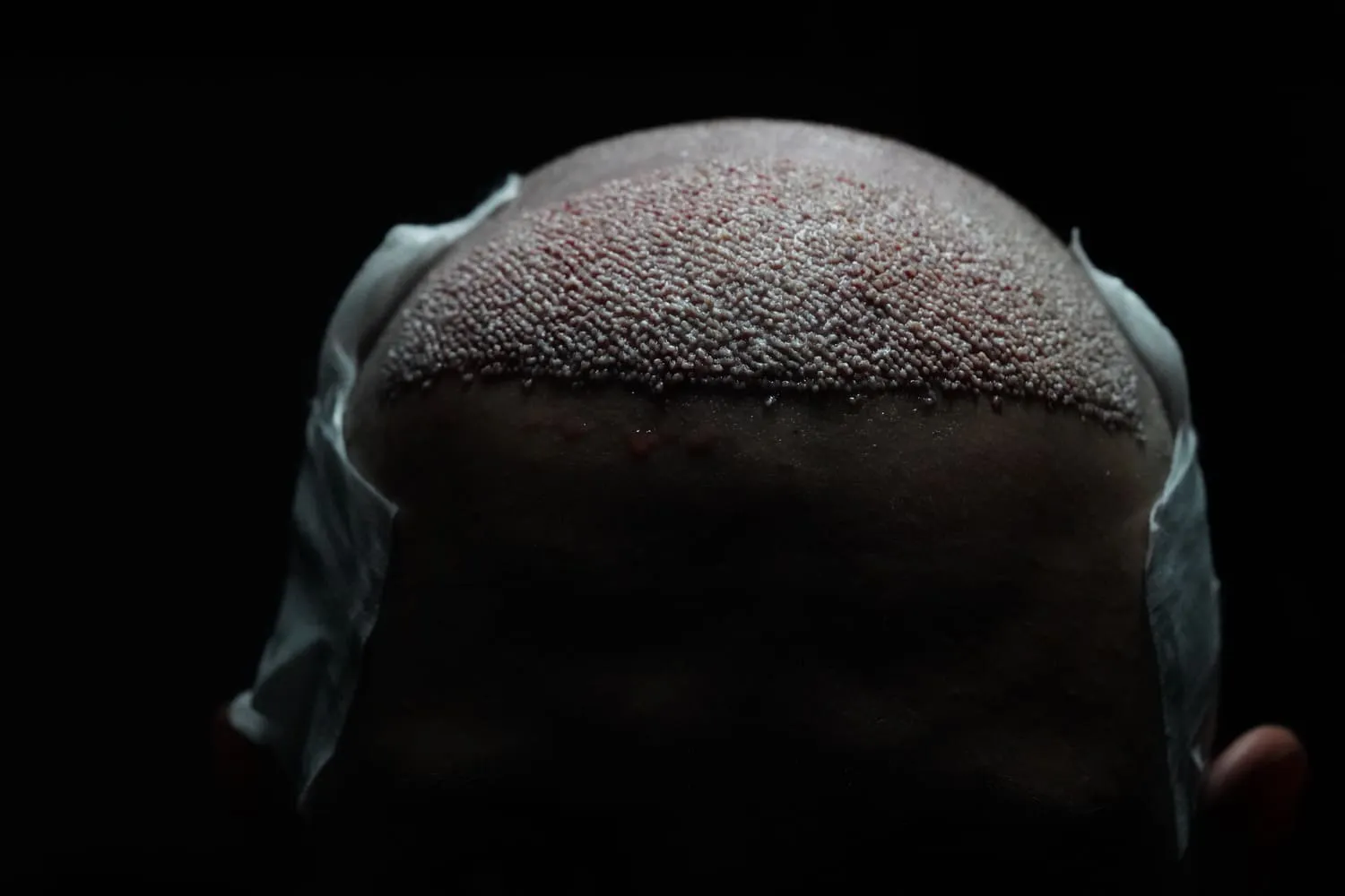 Haartransplantation: Schritt-für-Schritt-Anleitung
